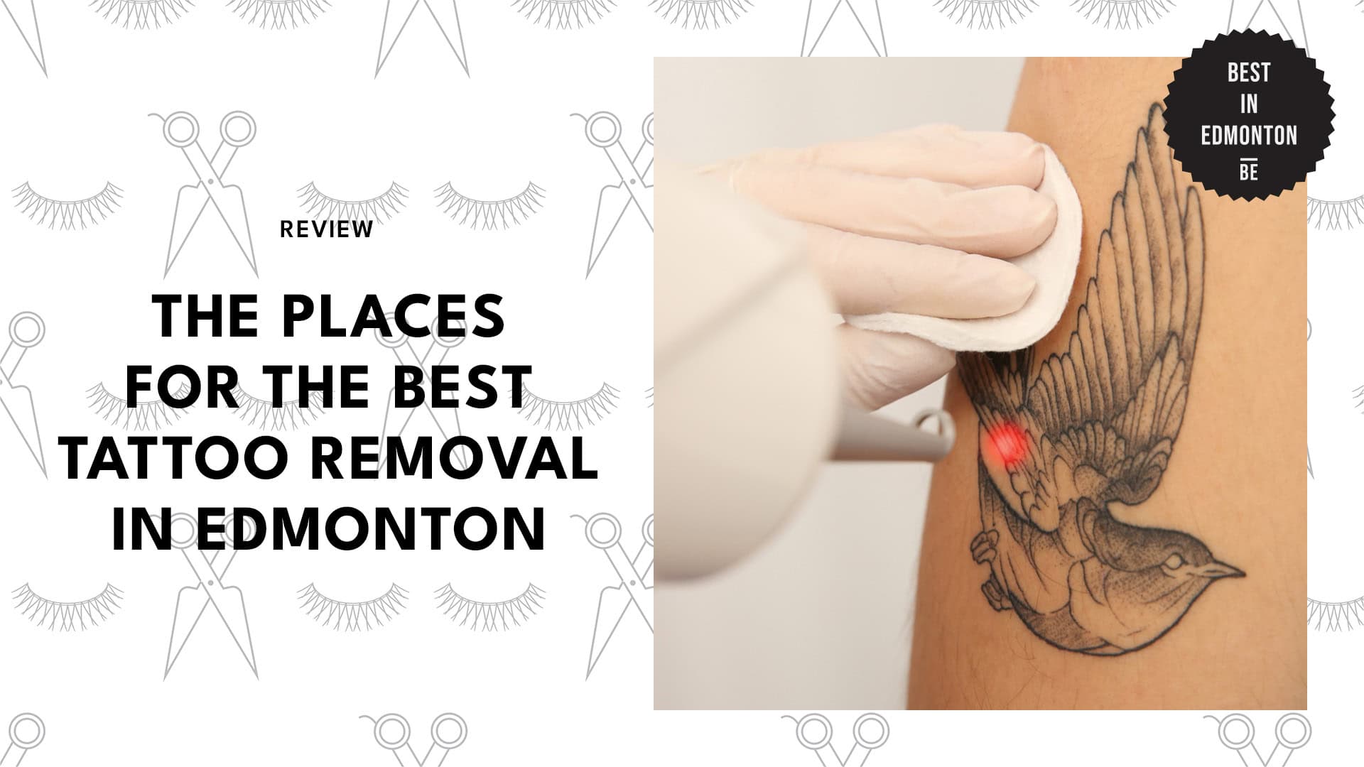 tattoo-removal-edmonton